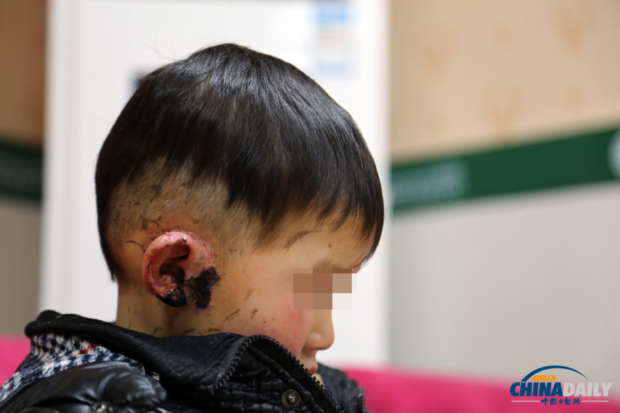 6歲男童慘遭嬸嬸割耳續(xù)：有醫(yī)院免費(fèi)為他造左耳