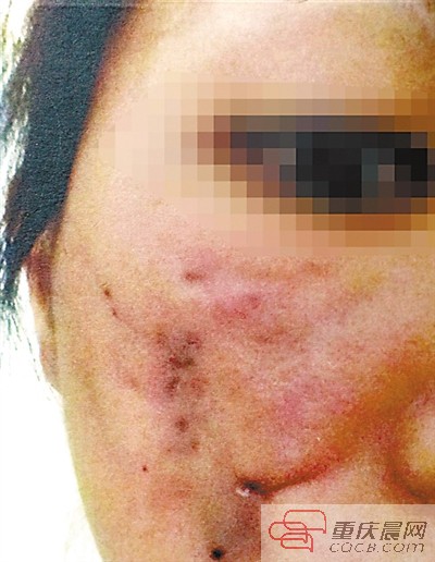 重慶美女手術后臉蛋腫脹發紫 整形門診被判補償12萬5