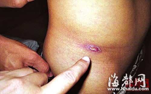 閩現多起恙蟲病例 廈門一男子險喪命