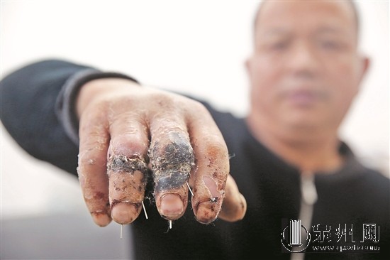 患者投訴醫院中指無名指錯接 醫院：要等鑒定結果