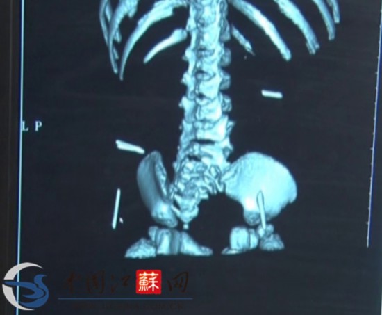 江蘇淮安女嬰體內取出4根縫衣針 或為人為扎入