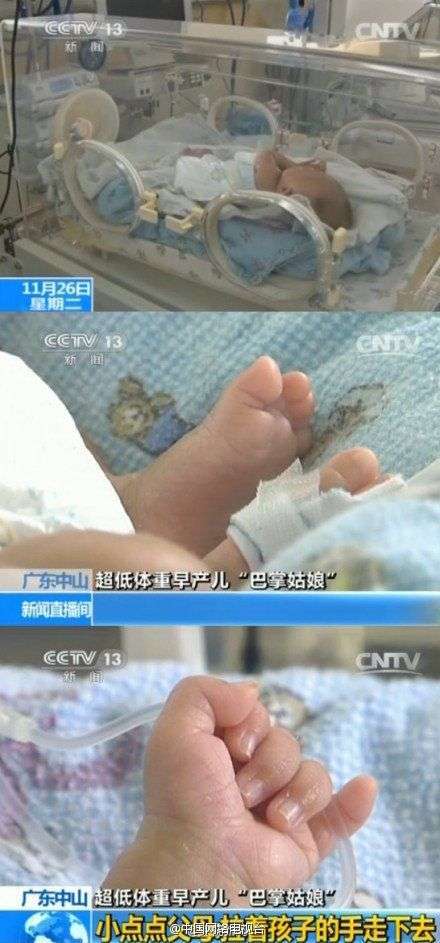 超低重早產兒“拇指姑娘”出生體重僅1斤1兩(圖)