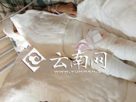 云南宣威3歲女孩被燙傷續：母親放棄治療女兒