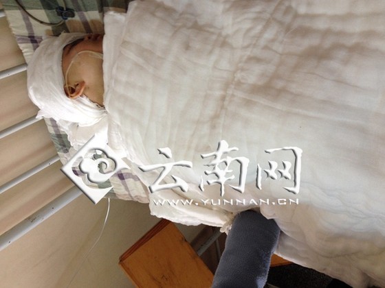 云南宣威3歲女孩被燙傷續：母親放棄治療女兒