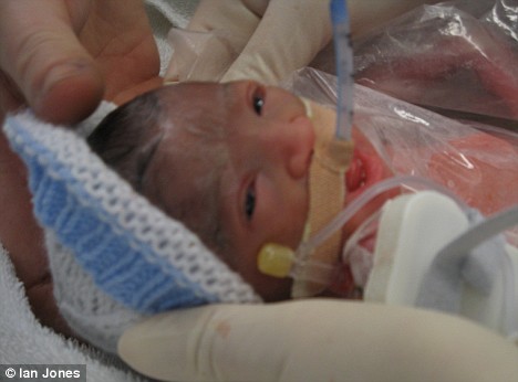 腦瘤引發腦溢血 英國女子死后兩天產下健康女嬰