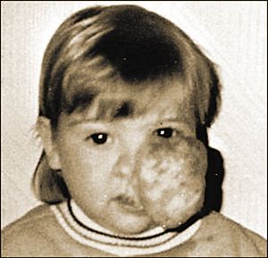 “腫瘤女孩”19次手術除瘤獲意中人