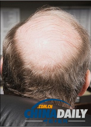 白發變黑將成真 “吸血鬼療法”有效治禿頂