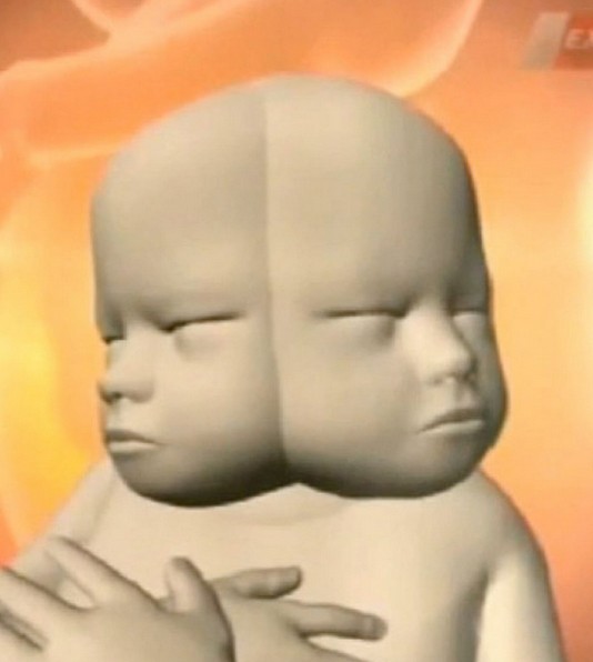 澳大利亞女子拒絕流產(chǎn) 將生下罕見“雙面”女嬰